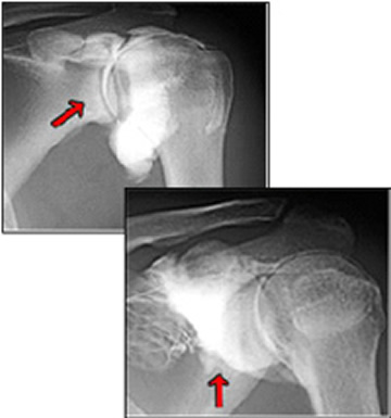 関節造影検査（Arthrography）とは？