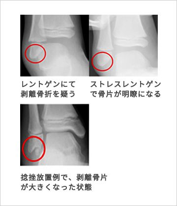 子供の足関節捻挫